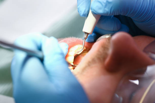 Best Emergency Tooth Extraction in El Paso, TX